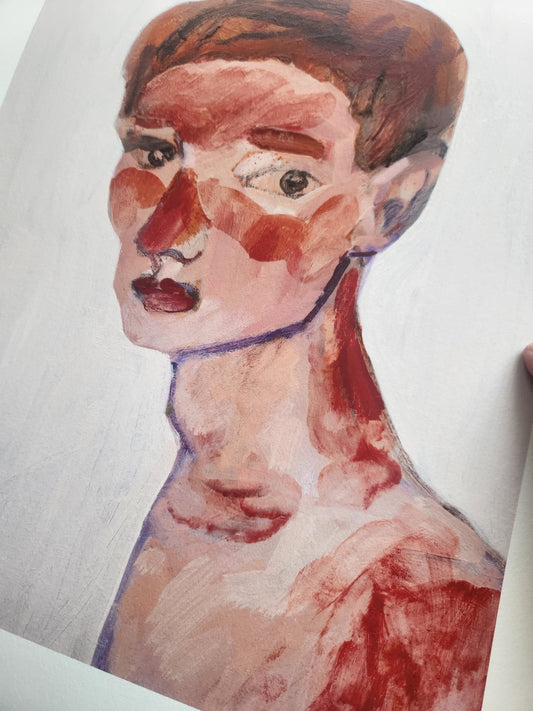 Sunburn - Ltd Edition Giclee