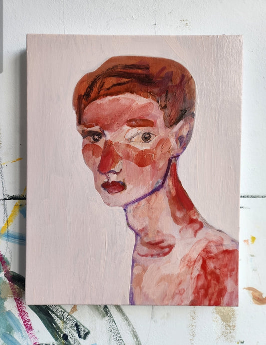 Sunburn